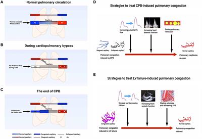 Pulmonary Congestion Due to Right and Left Heart Output Mismatching: A Case Report and Literature Review